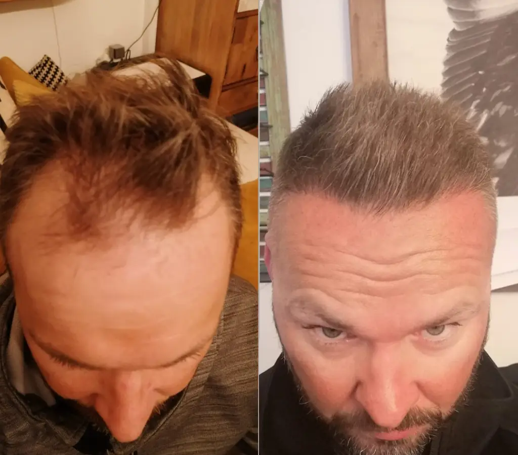 Hair transplant result 4
