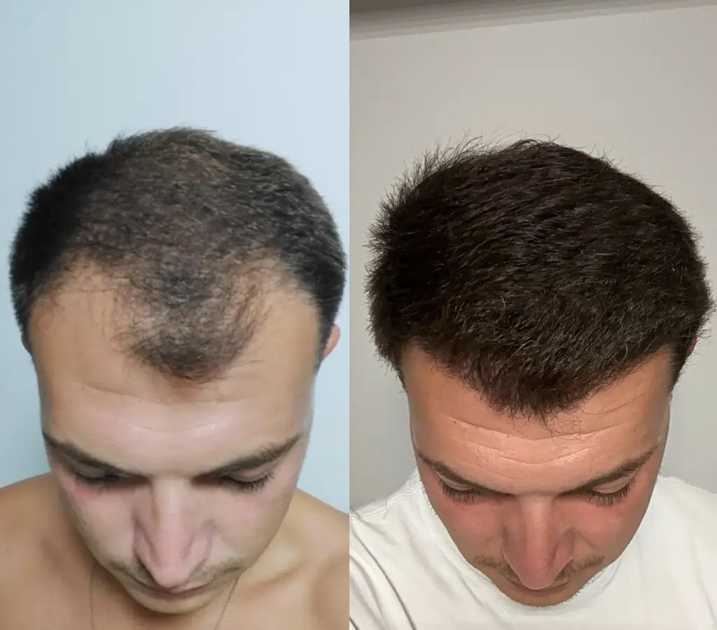 Hair transplant result 2